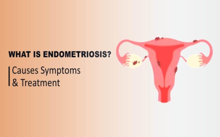 BEST DOCTOR FOR ENDOMETRIOSIS TREATMENT IN NOIDA