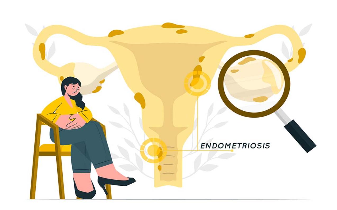 Homeopathic Treatment for Endometriosis: A Holistic Approach to Managing Pain and Discomfort