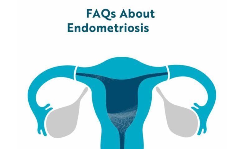 FAQs of Endometriosis
