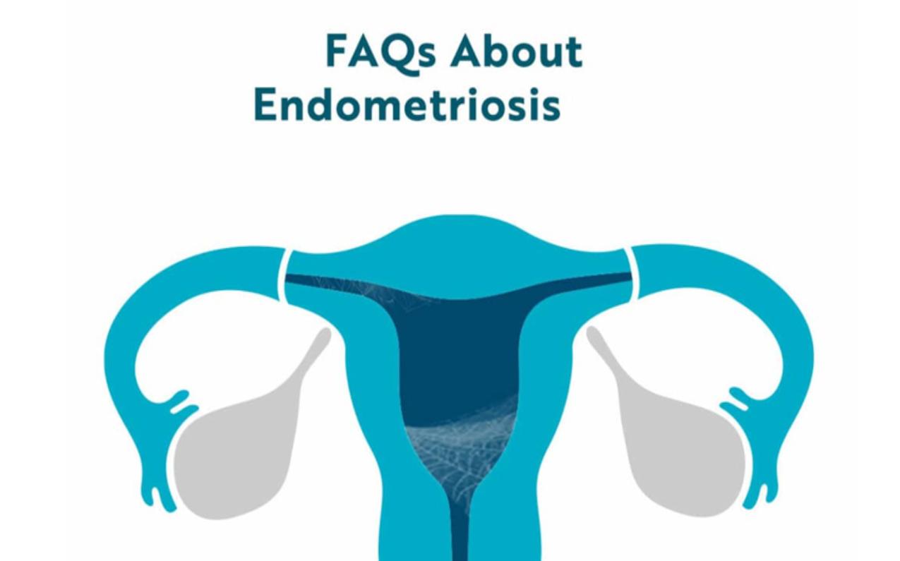 FAQs of Endometriosis