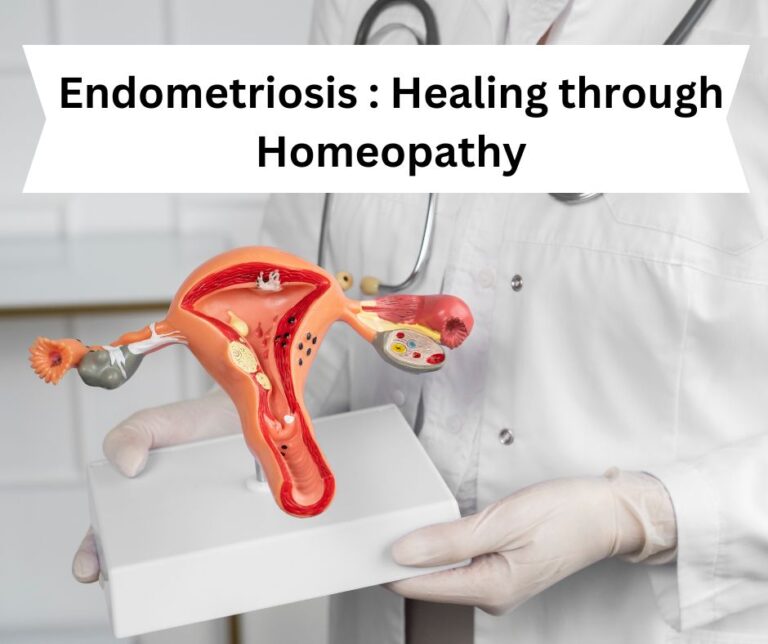 HOMEOPATHIC TREATMENT OF ENDOMETRIOSIS IN DELHI