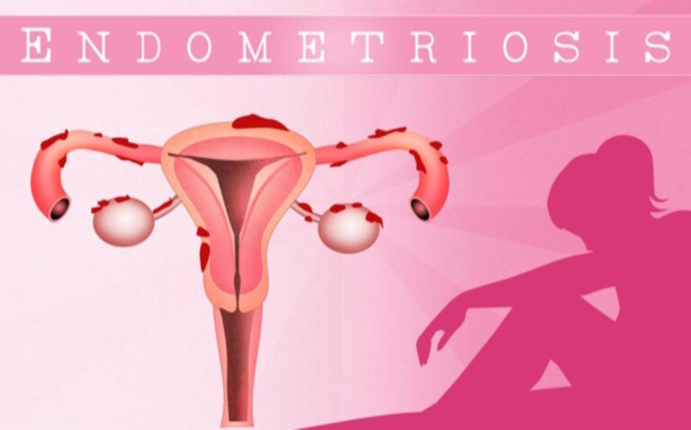 Holistic Healing: Combining Homeopathy, Diet & Lifestyle for Endometriosis Relief
