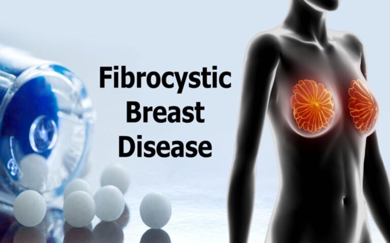 Fibrocystic Breasts and Homeopathy