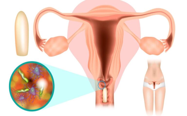 Vaginitis and Homeopathy