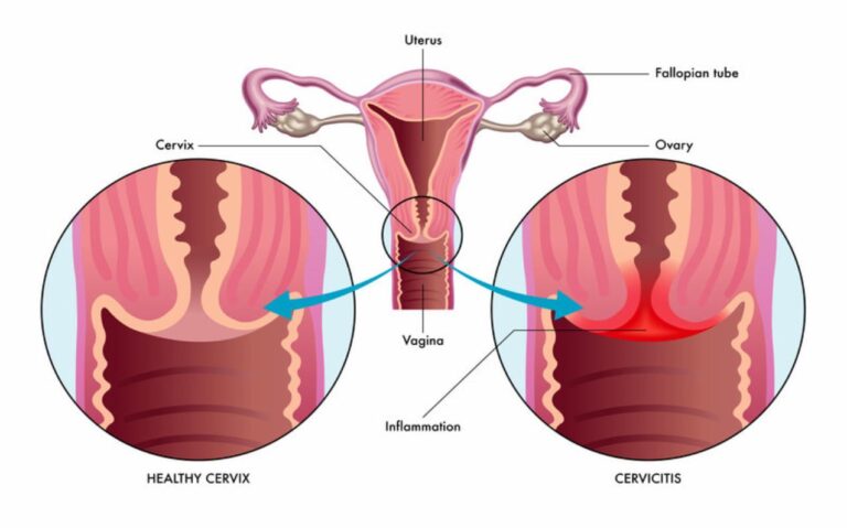 Cervicitis and Homeopathy: A Natural Approach to Healing