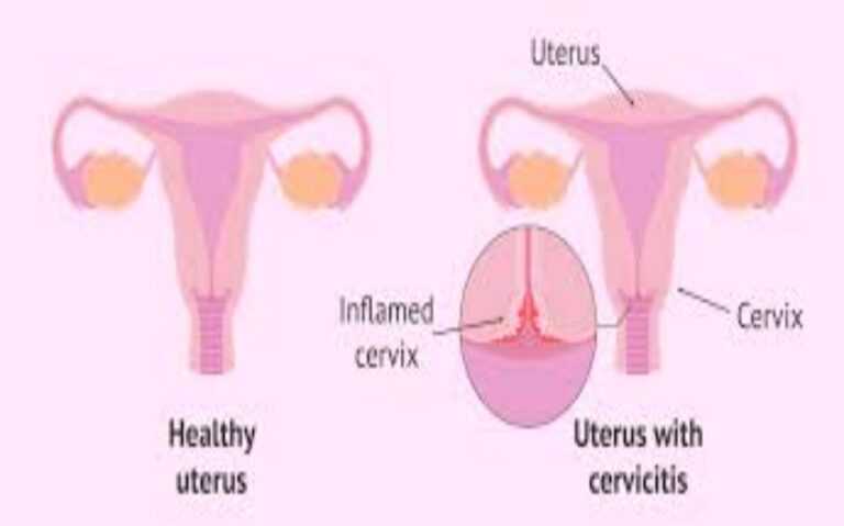 Can Cervicitis Be Cured by Homeopathy?